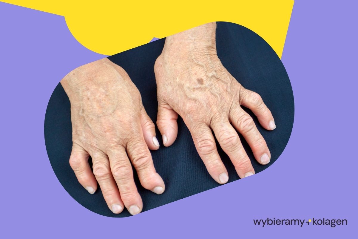Dłonie osoby z zaawansowanym reumatoidalnym zapaleniem stawów RZS