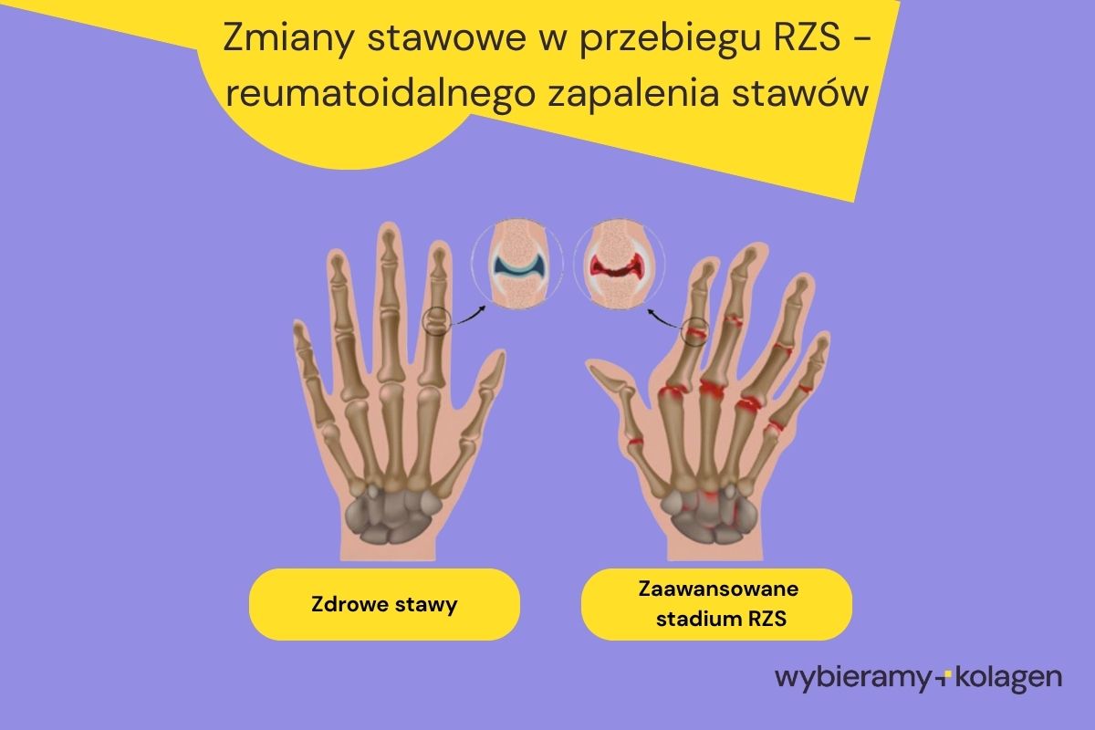 Porównanie stawów dłoni u osoby zdrowej i chorej na RZS reumatoidalne zapalenie stawów