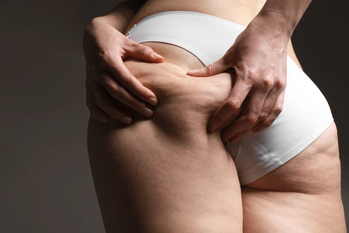 Cellulit na pośladkach