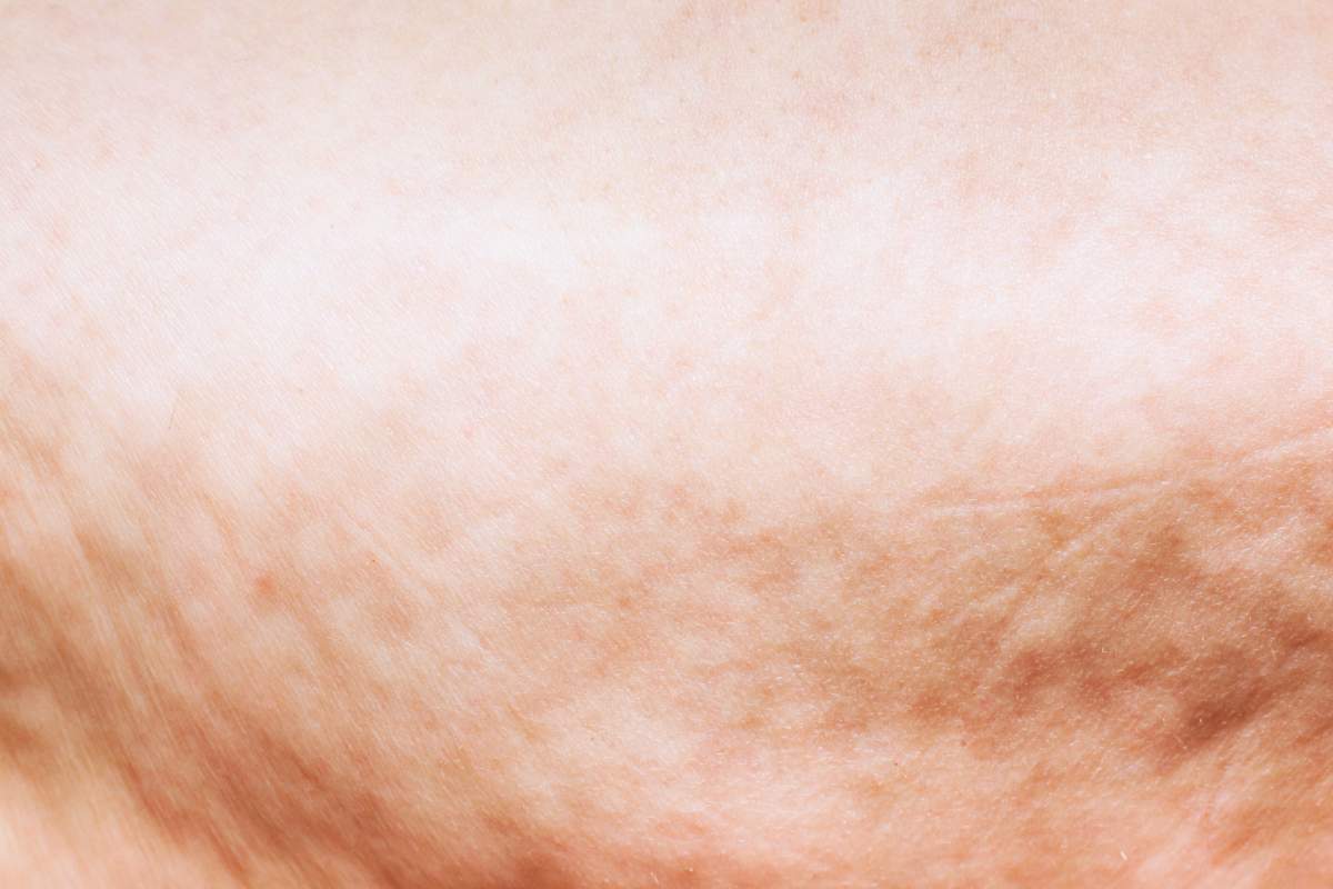 Cellulit na skórze z bliska