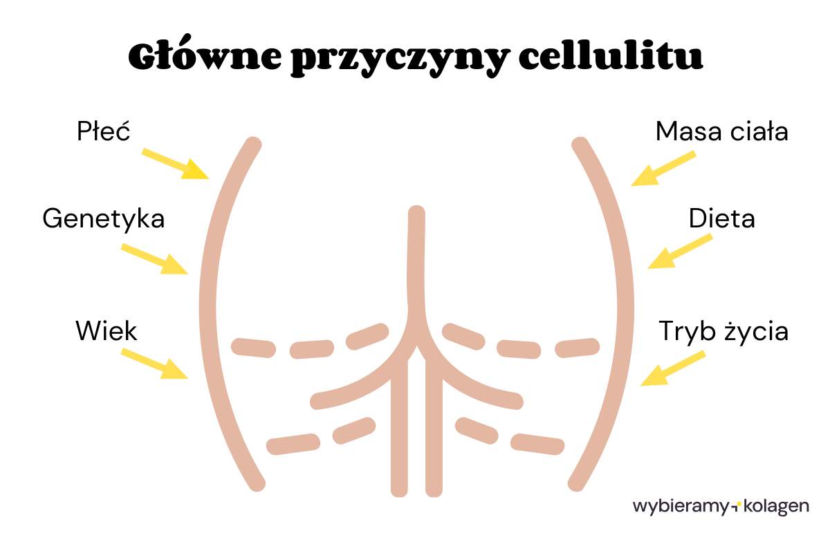 Infografika przedstawiająca główne przyczyny cellulitu